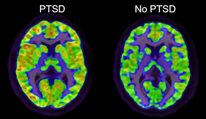 PTSD and Shell Shock