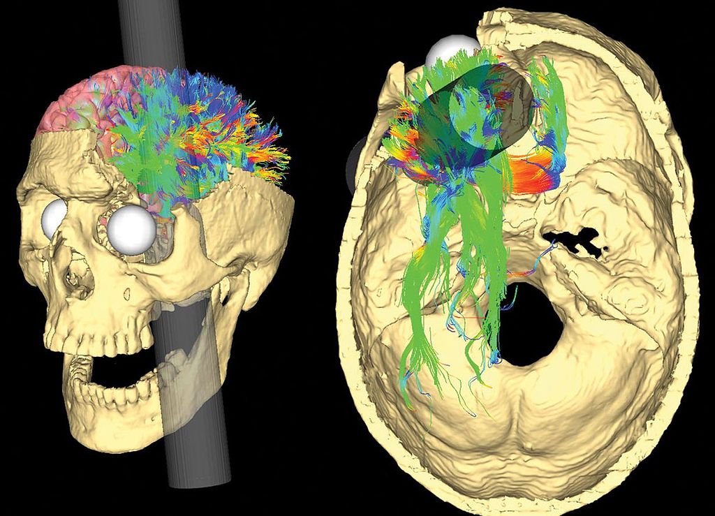 phineas-gage-an-ordinary-man-stmu-research-scholars