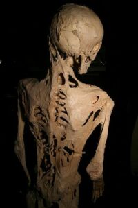 The skeleton of Harry Raymond Eastlack, who was known to have fibrodysplasia ossificans progressiva. Courtesy of Wikimedia Commons
