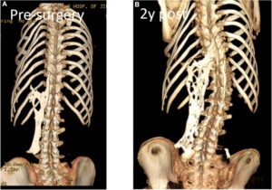 Computed tomography from before and after a surgery showing the effects of the flare up of FOP after the initial surgery(Sun et al., 2022)